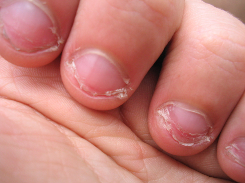 Onychophagy.thumb.jpg.b8cbf38c7731332d5ee1332a849e15eb.jpg
